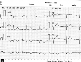 Nhồi máu cơ tim cũ thành dưới