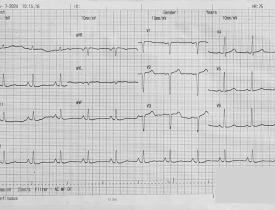 Phân tích ECG 2024 - ECG 1