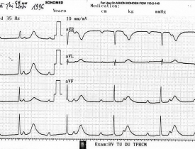 Block A-V độ III chủ nhịp bộ nối