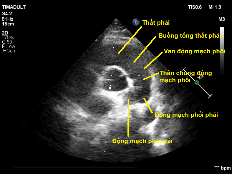 Hướng dẫn thực hiện siêu âm tim