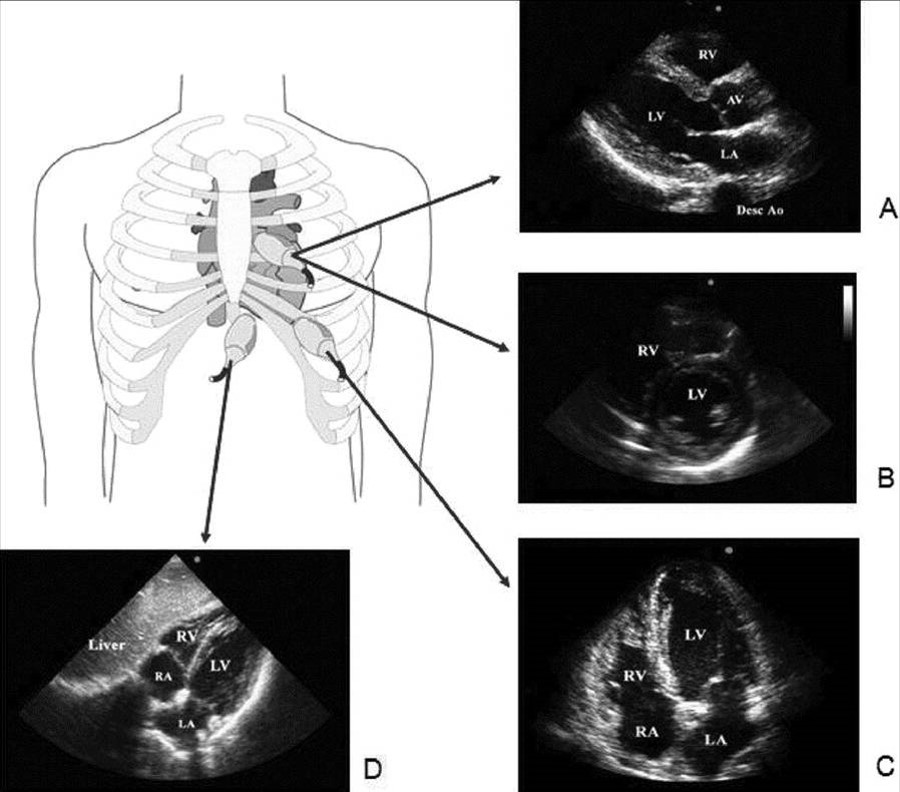 Mô tả tổng quan về siêu âm tim